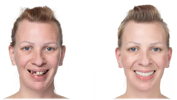 All-On-4-Plus Dental Implants - New Smile!