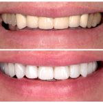 teeth whitening cost