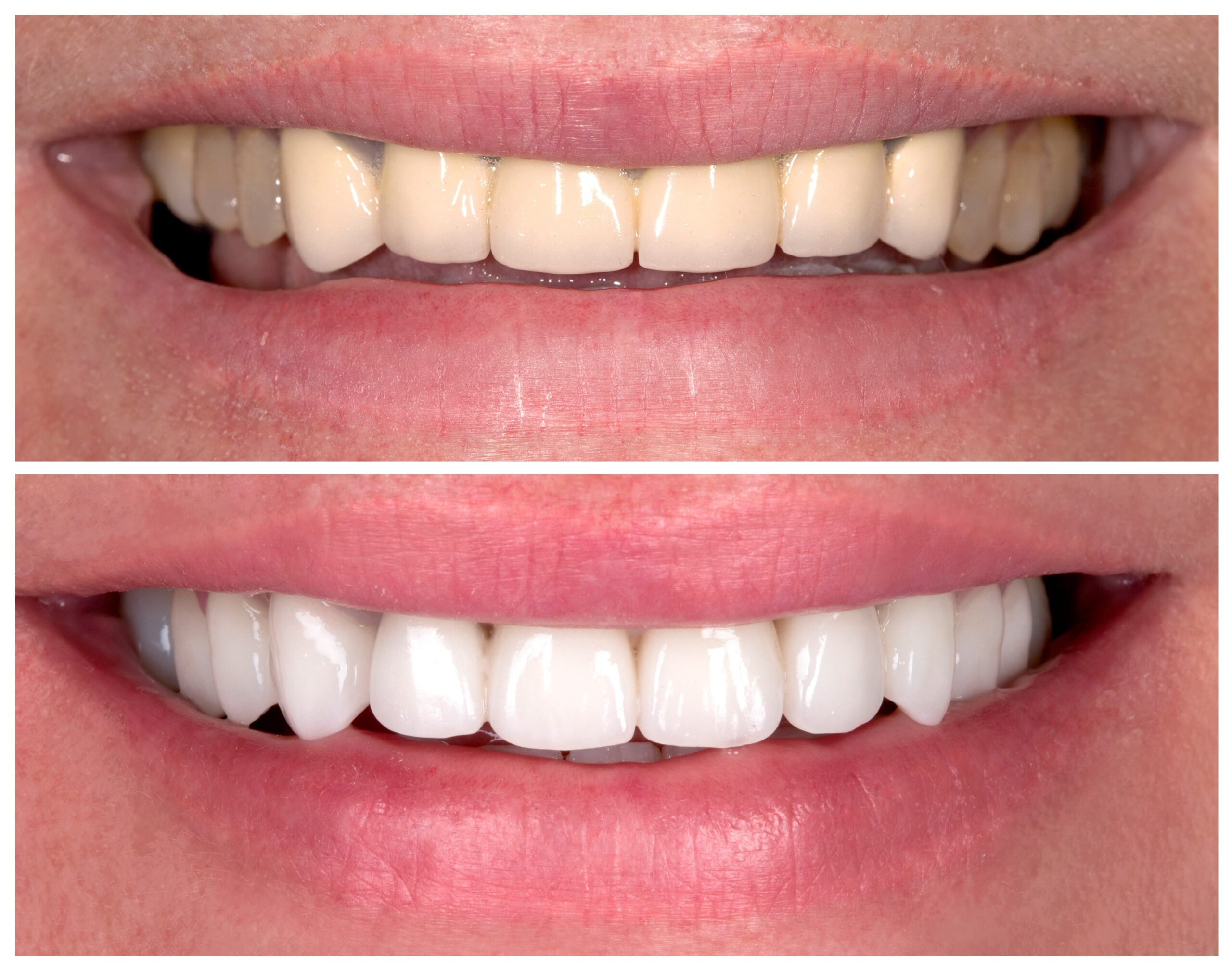teeth whitening cost