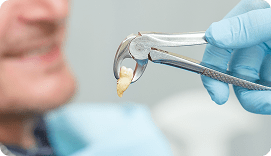 Tooth Extractions